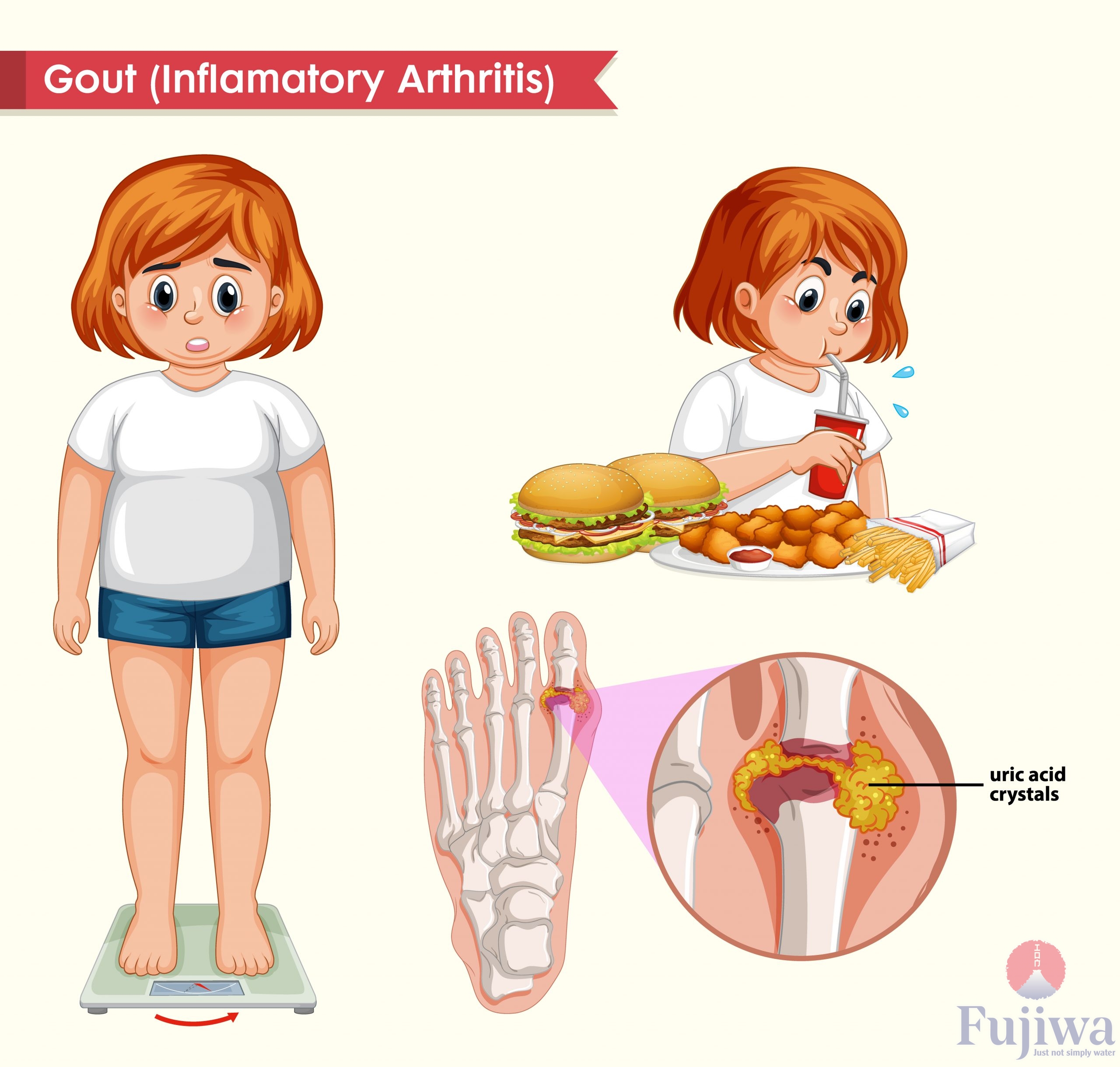 bệnh gout là gì